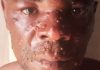 Kasaï : trois cas suspects de Mpox signalés à Luebo, dont un décès